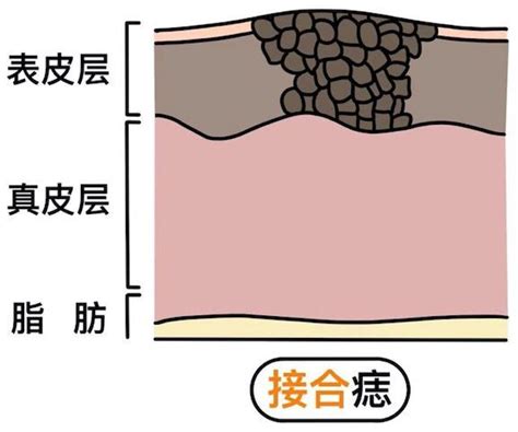 接合痣|見仁見「痣」